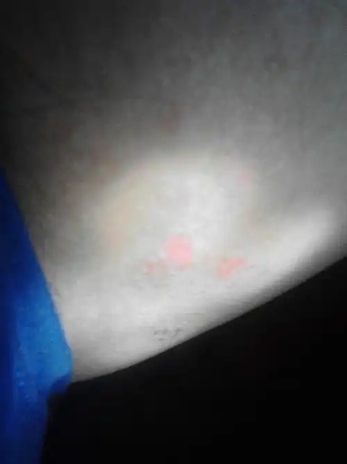 睾丸两侧皮肤瘙痒.这是什么病?上周开始的.以前也有过.但是自己好了.