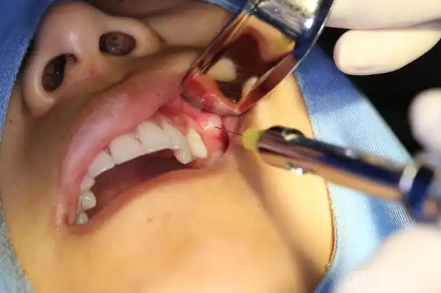 手术过程(碧兰麻局部浸润麻醉,当然涂表麻先)术前ct刘xx   女    b5