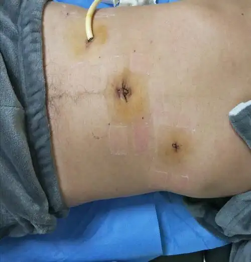 腹腔镜微创手术治疗胃十二指肠溃疡穿孔,只需打三个孔,总长度2cm,病人