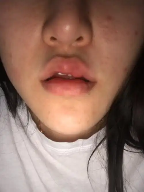 嘴上突然起了一个包怎么回事啊就肿了一块?求助