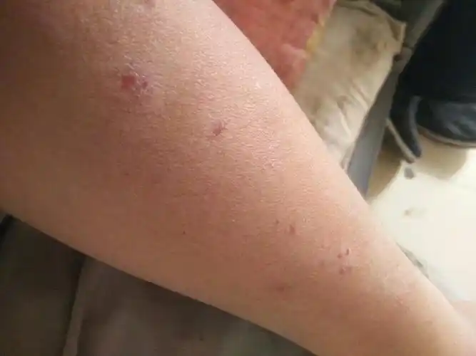 一到夏天胳膊就这样,还很痒,怎么办啊,过几天要相亲,好丑啊,求专业的