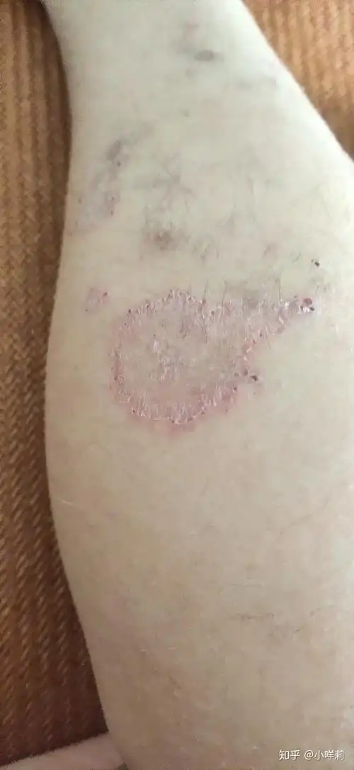 人得了猫癣怎么治疗啊急