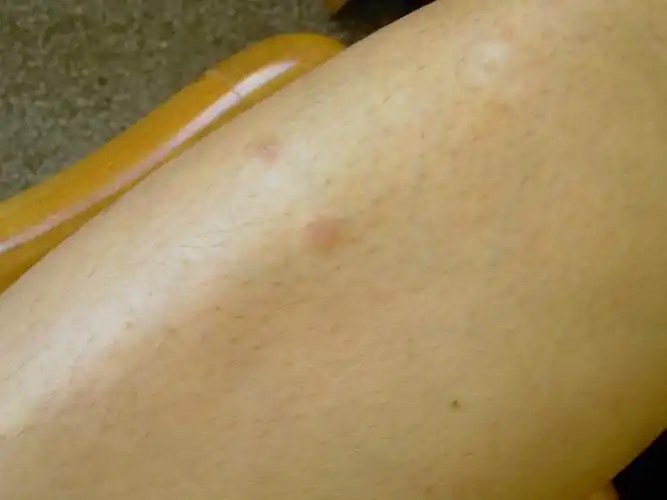 一个奇怪的皮疹(二期梅毒疹)