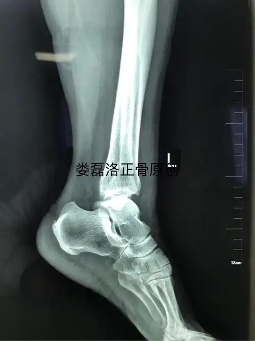 涉及内测三角韧带损伤的一例踝关节骨折