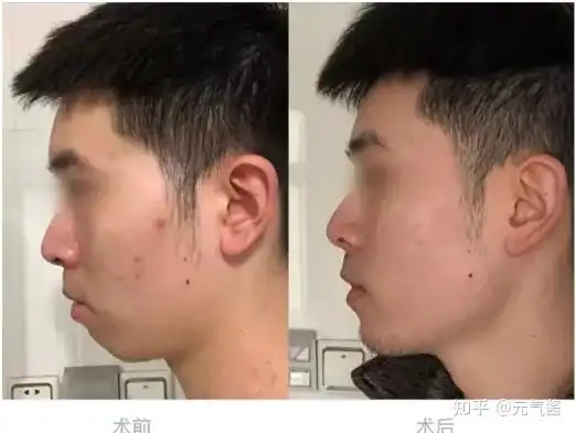 下巴究竟有多重要颏成型之截骨前移分享