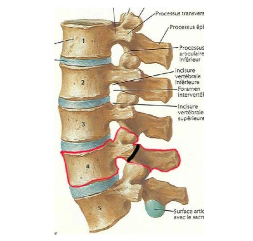 腰椎滑脱症伴有峡部裂是什么病该怎么办