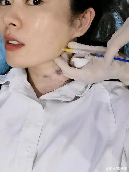 避坑!打瘦脸针脸凹了!