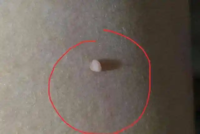 脖子与腋下的小肉粒是什么可以直接用手揪掉吗看完要记牢