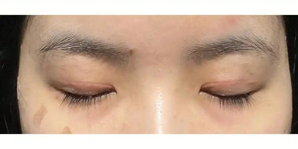 双眼皮术后增生期02