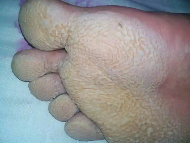 问:这脚是怎么回事,长时间碰水就这样,还有脚气,怎么办