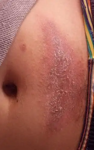 股癣症状有哪些