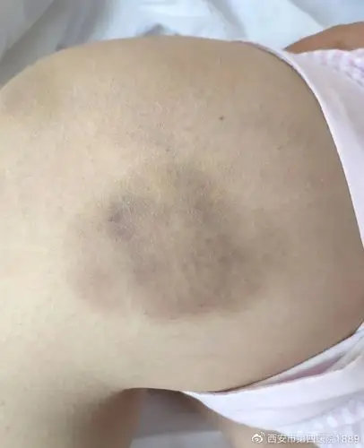 新院区运行花季少女突然鼻子出血身上多处瘀斑千万别大意