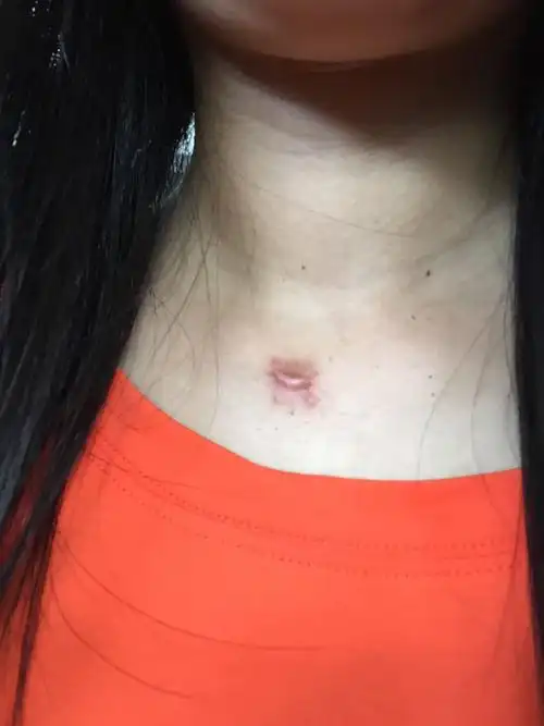 粉瘤,医生说对人体没有害,但是我觉得影响美观,我5月份在锁骨做个手求