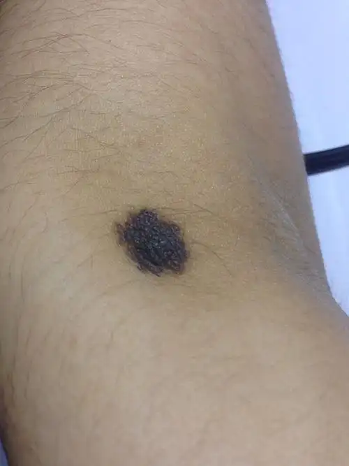 上面有毛有点凸起. 还有几颗痣是