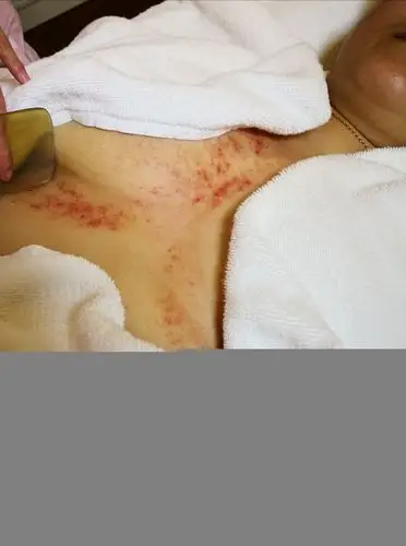 在大椎,肩井,小肠经,乳房四周,膻中穴刮痧,结节处不要刮,可以在结节的