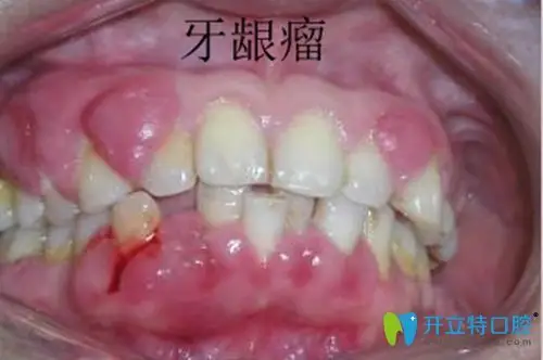 妊娠期牙龈瘤的症状图