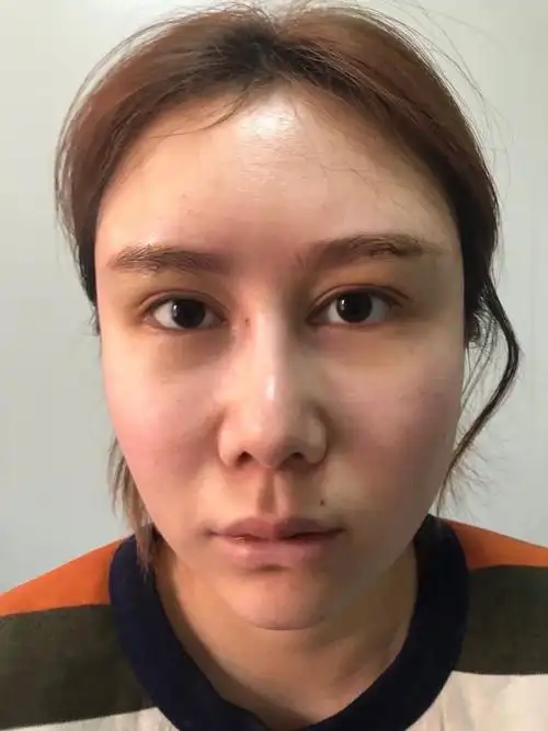 一直以来眉骨都比较凹陷,眼睛突出显得无神.