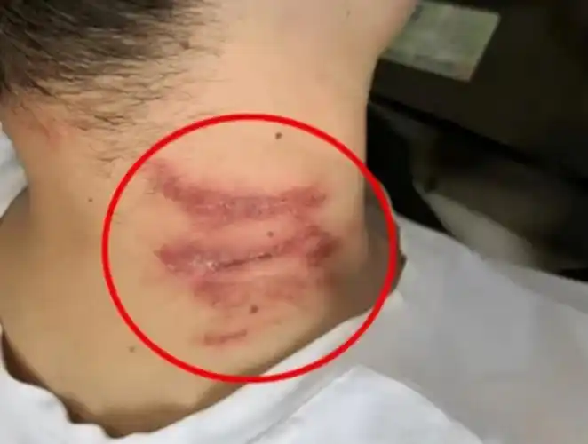 被隐翅虫咬伤急救指南,毒液酸性或可堪比硫酸?