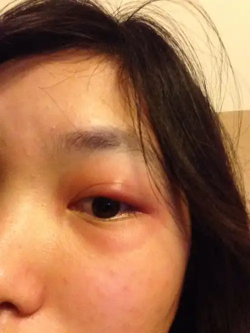 20岁 眼睛上眼皮肿了2天左右 红肿 发痒 请问是什么情况?求解答 如图