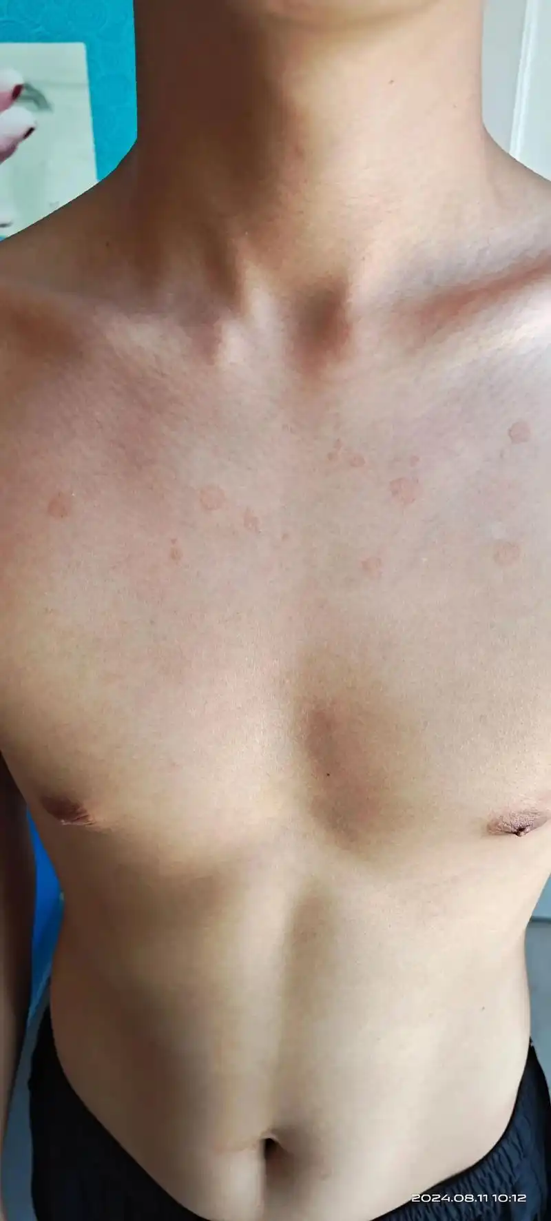 花斑糠疹:俗称"花斑癣"或"汗斑"#花斑癣 #花斑癣的辨别图 - 抖音