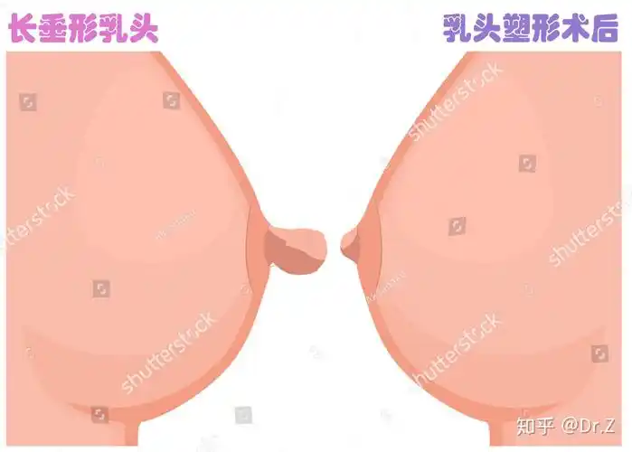 哺乳后乳房衰老三联征之乳头肥大乳头缩小术