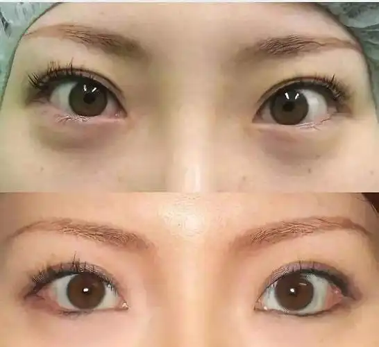 开外眼角外切下至两个多月,右眼(红色标记)下眼睑外翻,还有恢复的可能