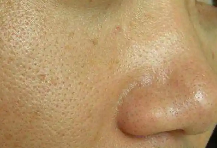 油性皮肤毛孔粗大怎么办改善油性皮肤毛孔粗大的小方法