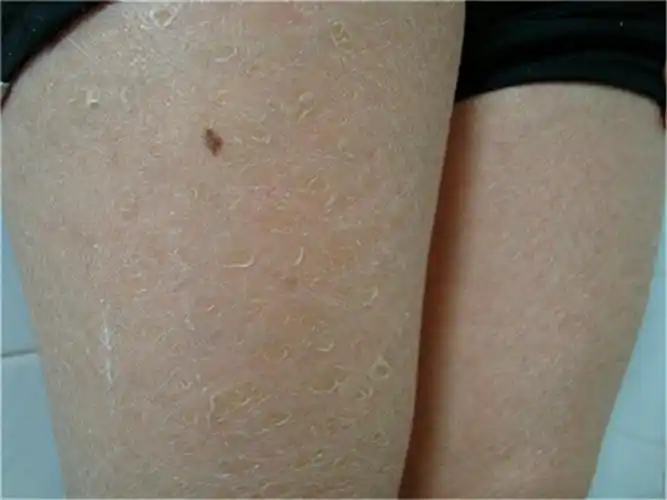 角样鱼鳞病图片_有来医生