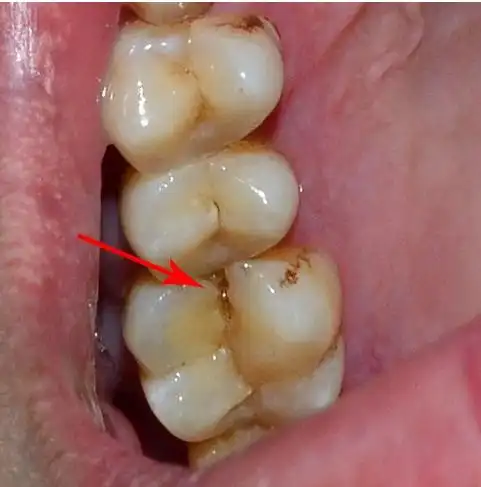 牙隐裂的裂纹常深入到牙本质结构,是牙齿敏感及牙痛的原因之一.