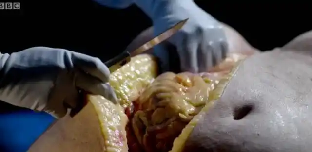 carla在解剖时说,感觉就是黄油,而且是惊人的厚度.