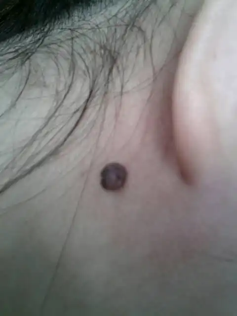 我怀孕后这颗痣就长大了,以前是平的,现在摸起来还有点刺痛!