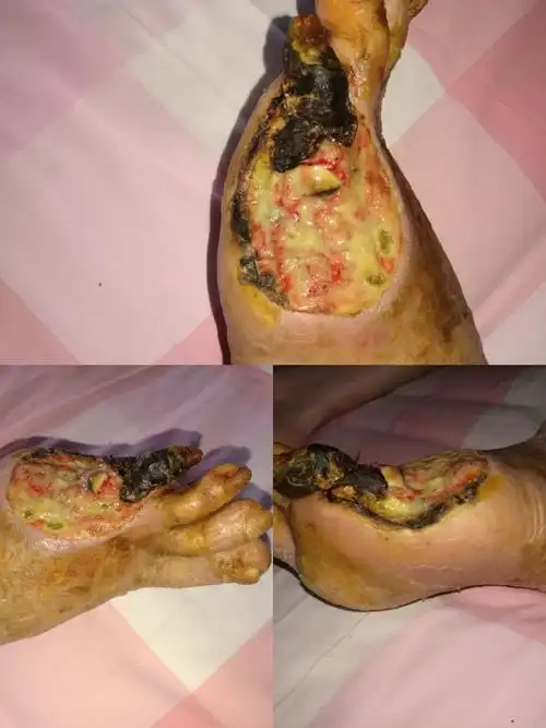 某,男,72岁,以"左下肢凉痛伴跛行7年余,左足溃烂12个月"为主诉收住院