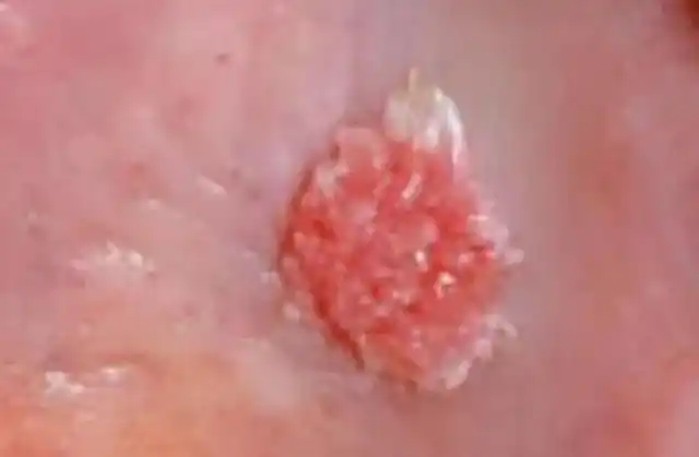 菜花状尖锐疣是高危病毒吗-菜花状疣怎么得的-名医汇