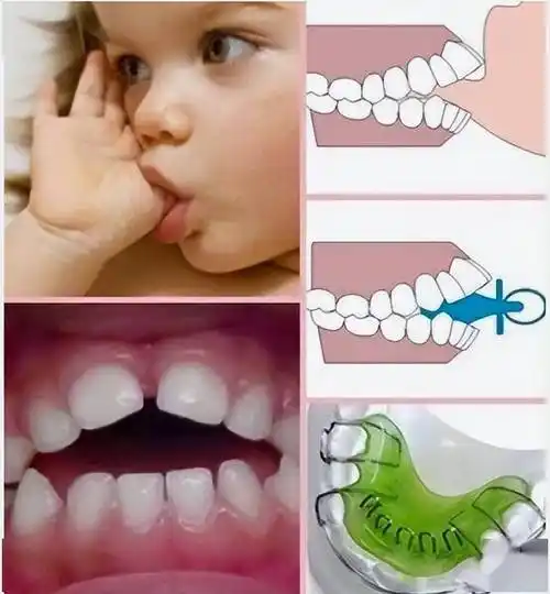 朱珠带娃被批:再不戒掉安抚奶嘴,真的会影响女儿颜值_宝宝_孩子_牙齿