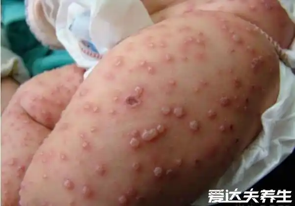 水痘症状图