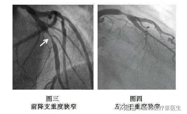 做完心脏造影后需要休息多久