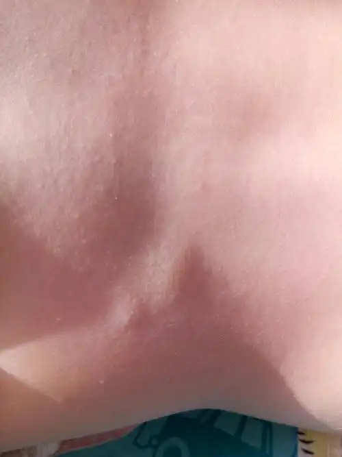 宝宝后背腰部长了一个硬块肉肉是什么东西只看楼主