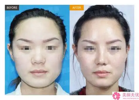 整形医院鼻部整形失败修复推荐:鼻部整形失败修复医院前