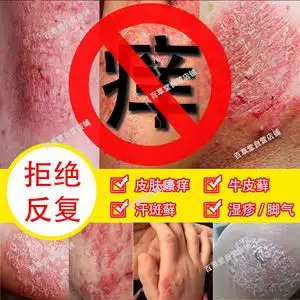 凡士林药用皮肤百草安柠舒灵银病头皮癣特效癣药膏玉柠红膏康屑沣