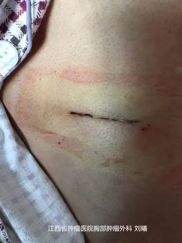 肺癌微创手术从多孔到双孔,从双孔到单孔. - 好大夫在线