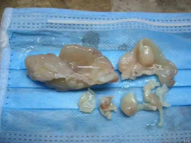 晒几张鼻息肉图片