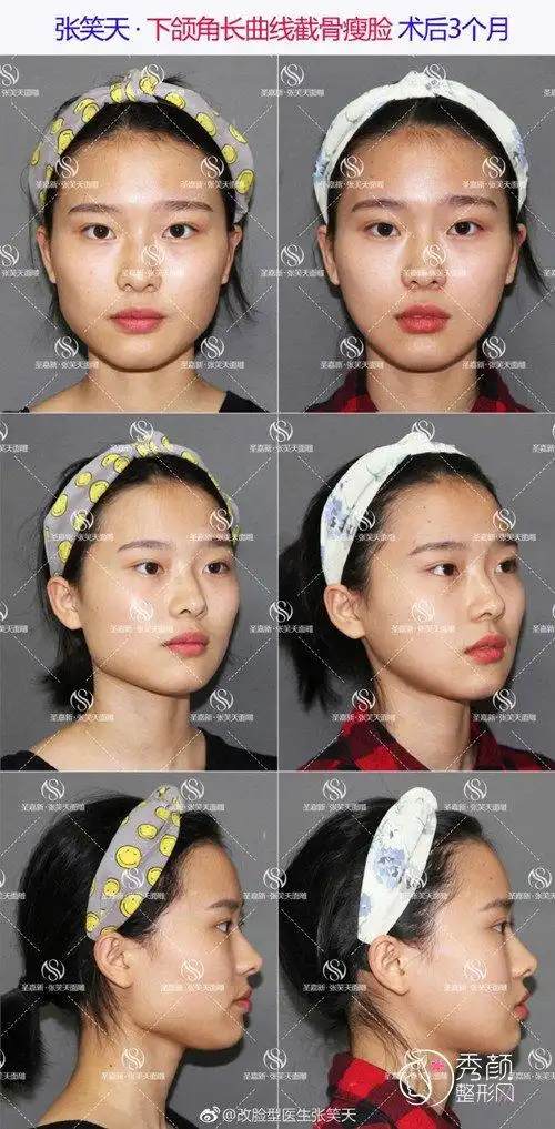 张笑天和黄大勇做磨骨怎么样,哪个好?_整形整容医院|微创手术