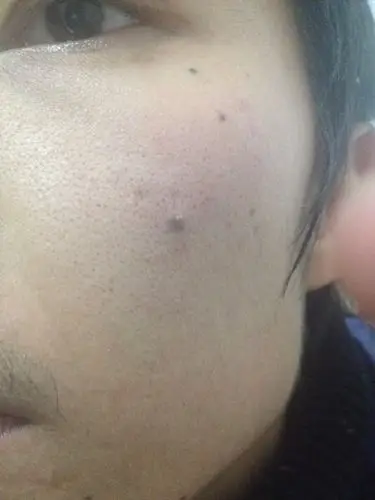 1,采取激光或者冷冻来治疗可以快速去掉黑痦子黑痦子又名黑色素痣