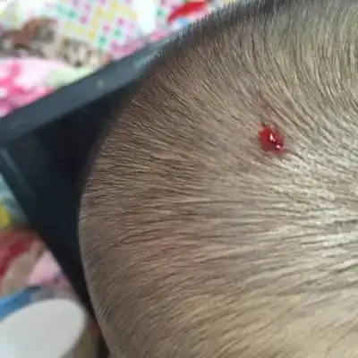 刚刚宝宝撞暖气片上了头出血了现在出血水了用上医院
