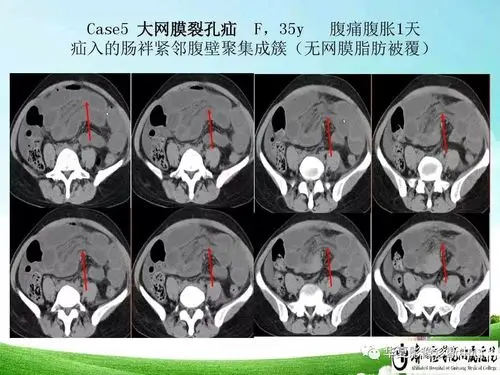 腹内疝的影像诊断要点