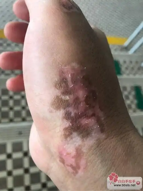 第二次表皮移植,昨天拆线!