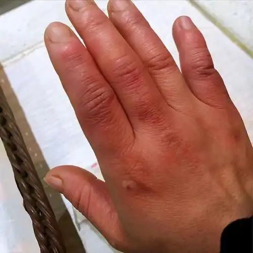 红肿冻疮有救了!3个过来人自用小妙招!28天在家恢复光滑肌肤!