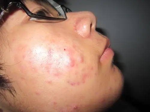 我长这样的青春痘的原因是什么?怎样治疗?