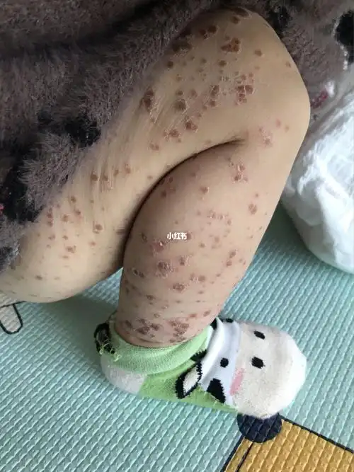 14个月宝宝手足口第6天恢复期