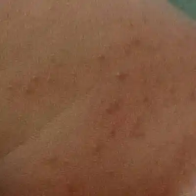 我家宝宝出生17天了,现在大腿上长了小痘痘,小痘痘是怎麼引起的,怎麼